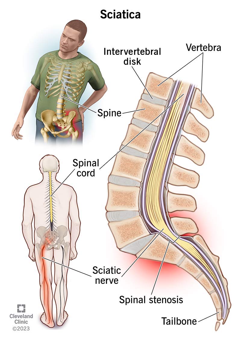 sciatica-nerve-pain-and-location-on-body
